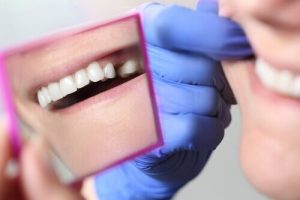 Excessive Bleeding After Tooth Extraction Treatments
