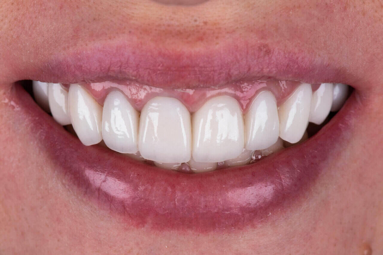 Full mouth reconstruction using dental implants.