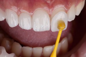 veneers as dental restoration